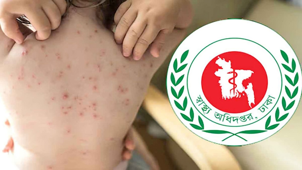 হামে আক্রান্তের সংখ্যা ছাড়াল  ১৮ হাজার, মৃ/ত্যু ১৬৪