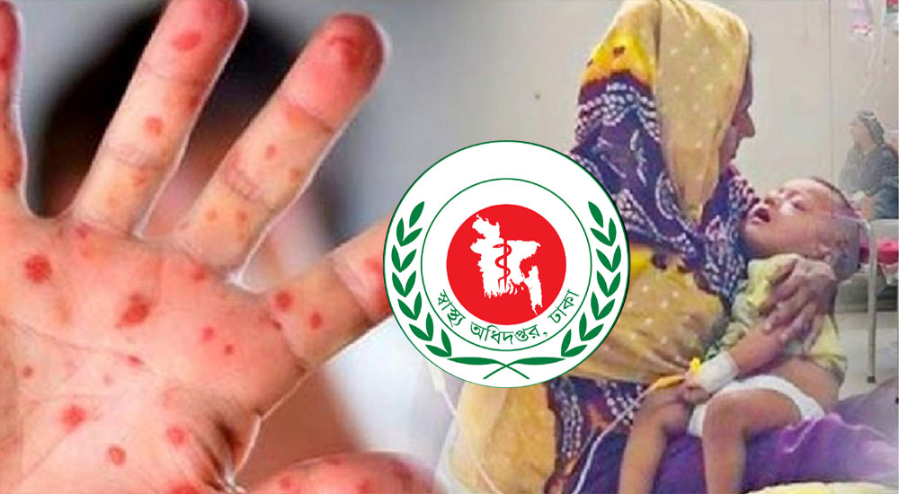 ২৪ ঘণ্টায় রামেকে হামের উপসর্গে ভর্তি ১৫